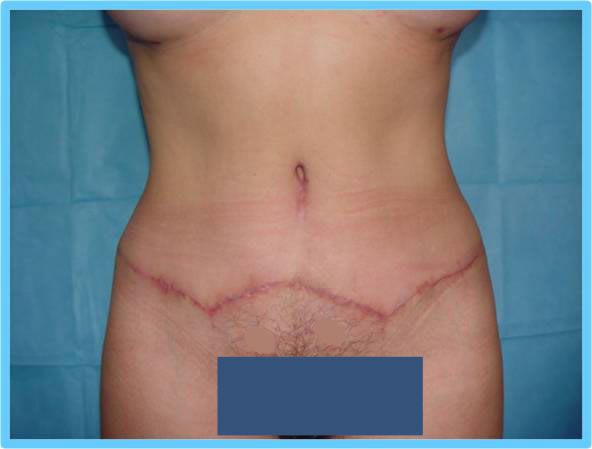 cirugia estetica de abdomen